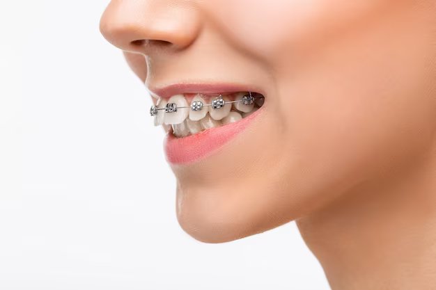 clear aligners, ceramic material, fixed braces, straighten teeth, clear ceramic brackets, oral hygiene